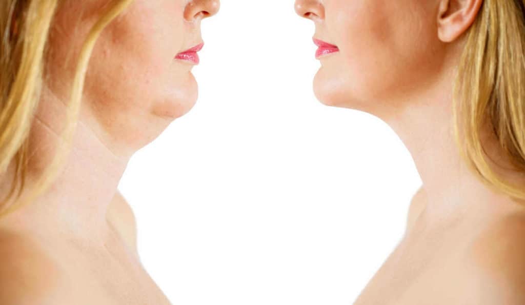 Double Chin treatment Waltham Cross before and after results