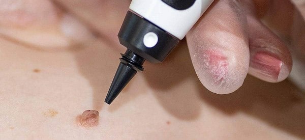After Skin Tag Removal Waltham Cross