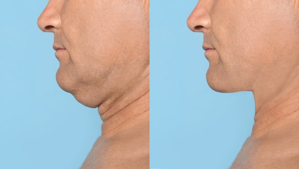 Which Non-Surgical Treatments Work Best for Jowls and Loose Skin Waltham Cross?