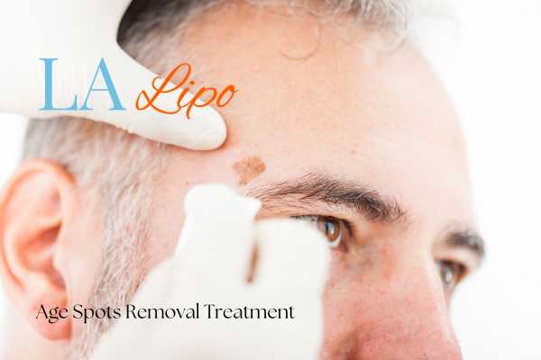 What Are the Most Effective Treatments for Age Spots Waltham Cross?