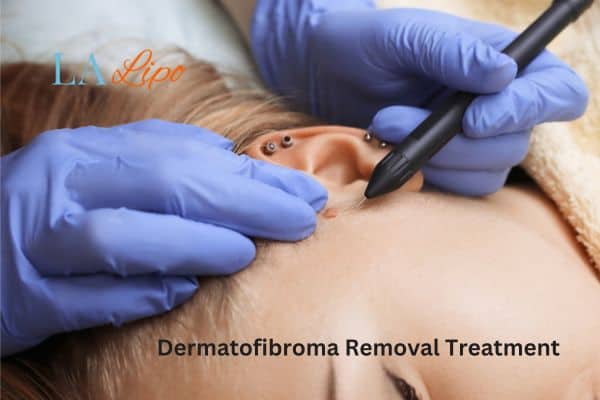 Dermatofibroma Removal Treatment Waltham Cross