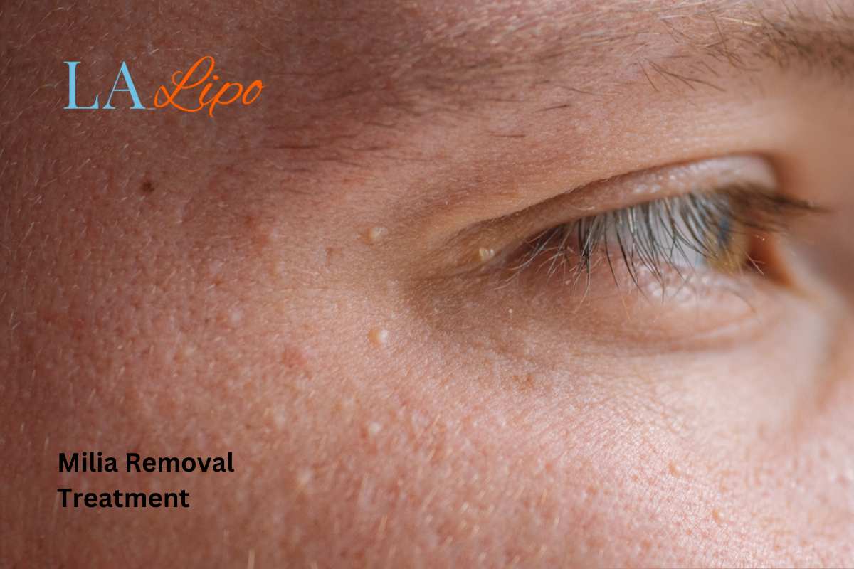 Cryopen Milia Removal: Is It the Easiest and Safest Option Waltham Cross?