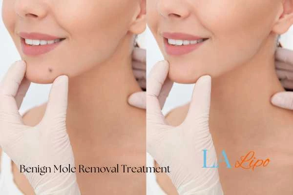 woman's before and after mole removal Waltham Cross results