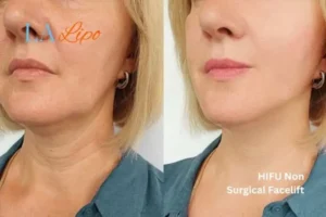 hi-fu for wrinkles Waltham Cross before and after results