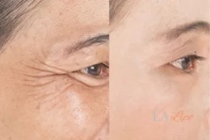 Before and after results of woman - HI-fu wrinkles reduction treatment Waltham Cross