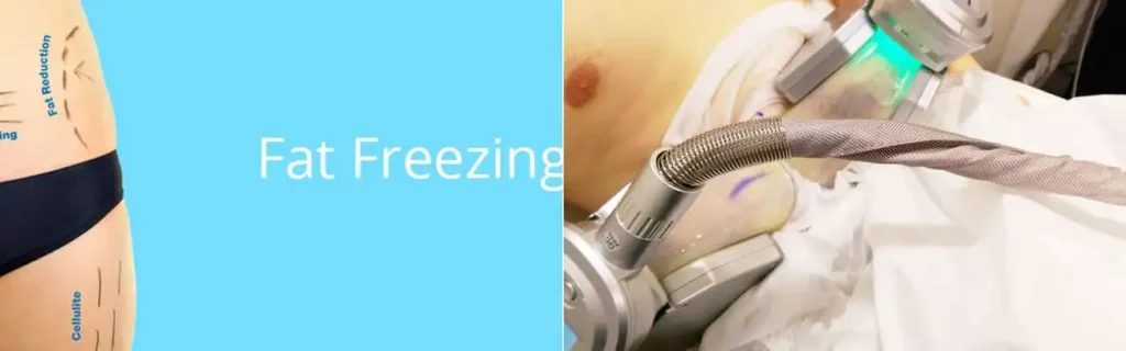 Fat freezing Waltham Cross on multiple areas of the body