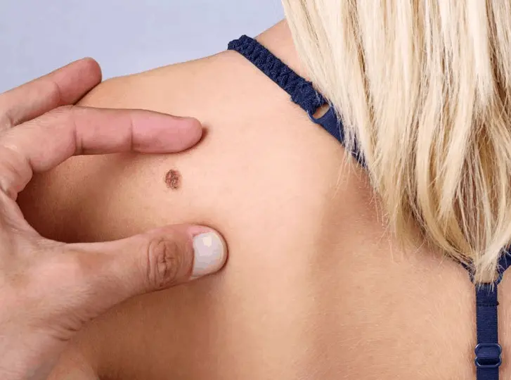 woman having mole removal Waltham Cross consultation before treatment.