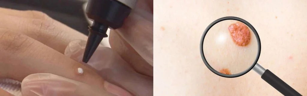 CryoPen practitioner Waltham Cross assessing a benign mole before treatment
