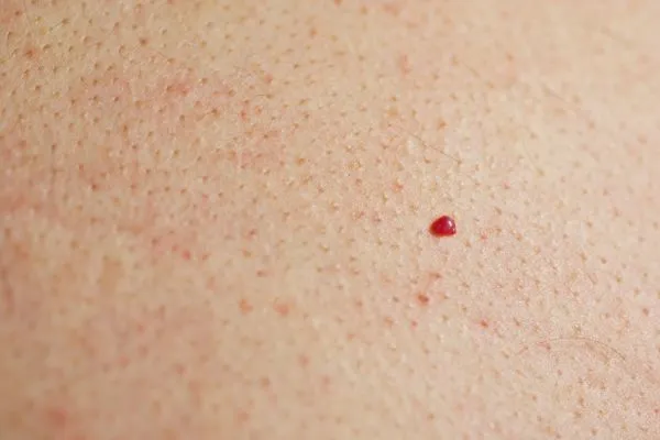 close up of a cherry angioma Waltham Cross
