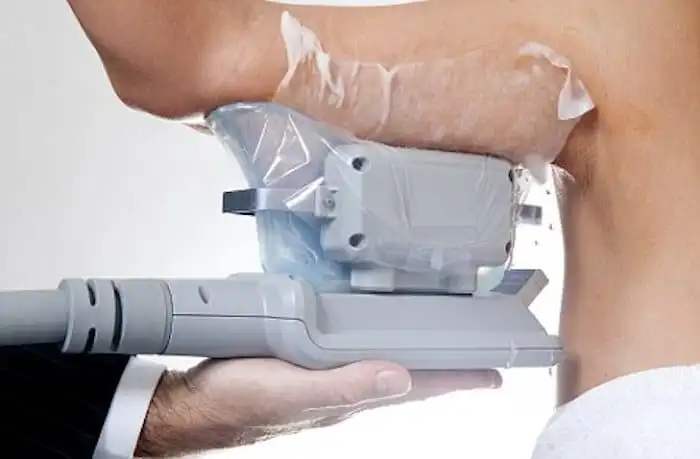 Picture of fat freezing Waltham Cross on the upper arms.