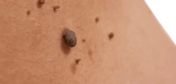image of a skin tag Waltham Cross