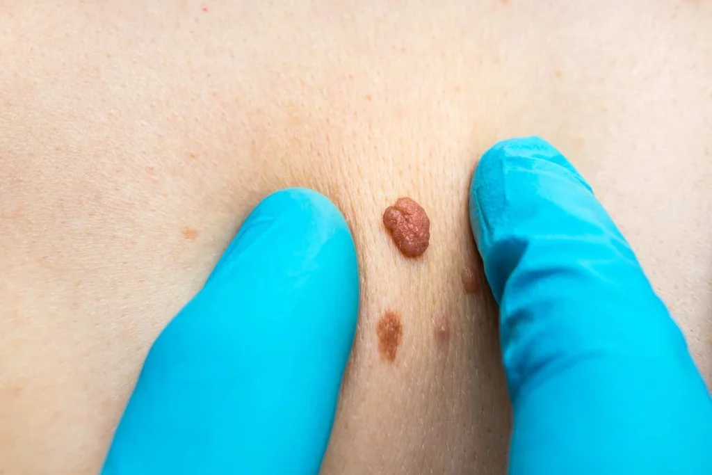 Consultant examining a skin tag Waltham Cross