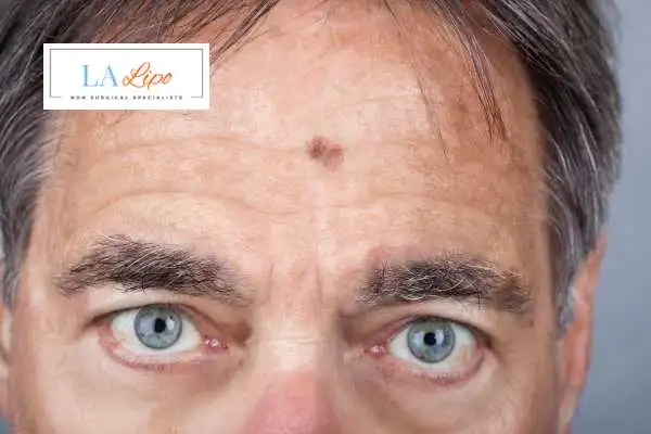 Solar Lentigo Removal Waltham Cross image of man with mark on his forehead