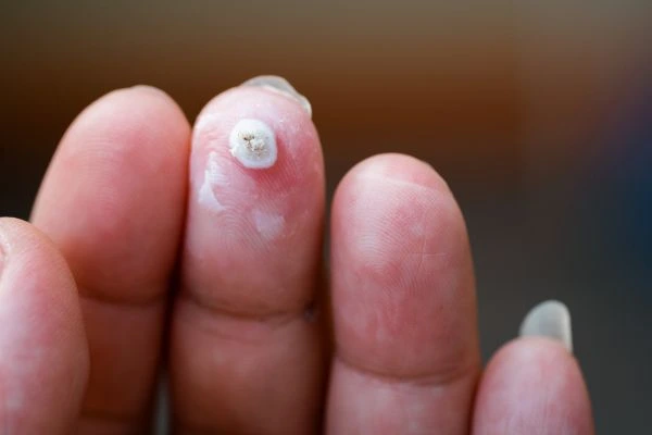 wart on person finger - cryotherapy to treat from LA LIPO Waltham Cross