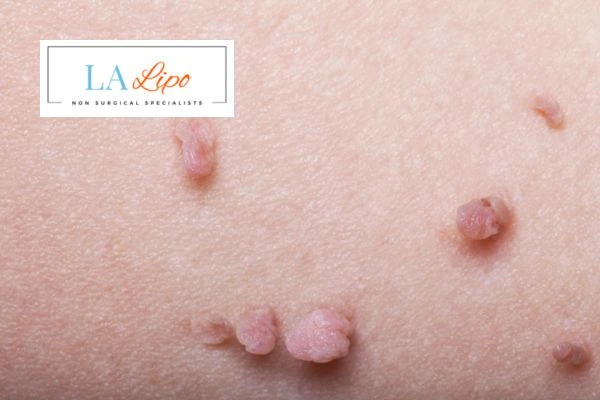 Does cryopen skin tag removal Waltham Cross hurt? Find out now call our team today!