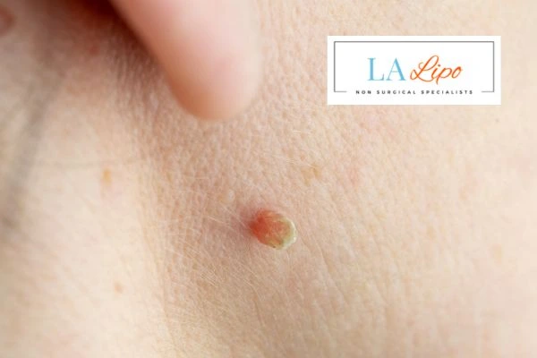 Book skin tag removal Waltham Cross today speak to our team now!