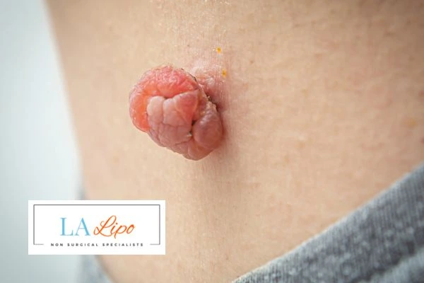 Interested in skin tag removal Waltham Cross? Concerned about the pain? Find out more today!
