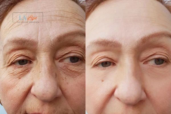 The powerful benefits of Morpheus8 Treatment Waltham Cross - Call Our team today!