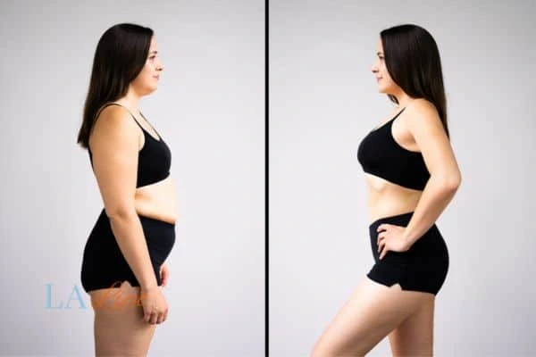Picture of womans before and after using LA-EMS body sculpting to improve her core strength Waltham Cross