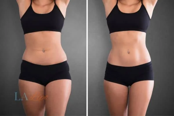 before and after results of non-surgical treatment to help a woman's body image and mental health Waltham Cross