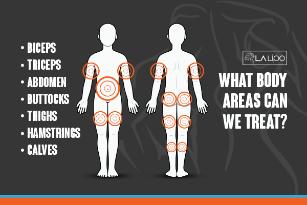 Diagram to show areas you can have LA-EMS Body Sculpting Treatment Waltham Cross
