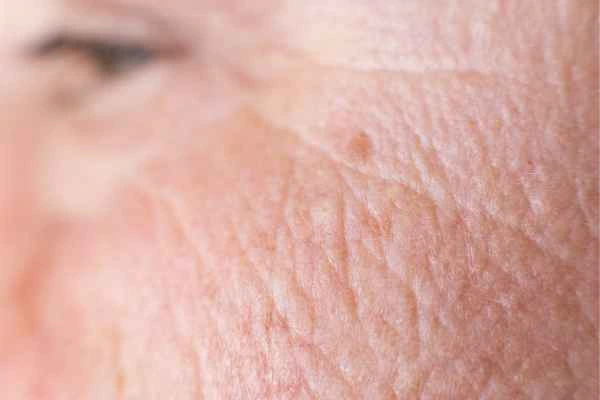 close up picture of a woman's face showing an age spot Waltham Cross