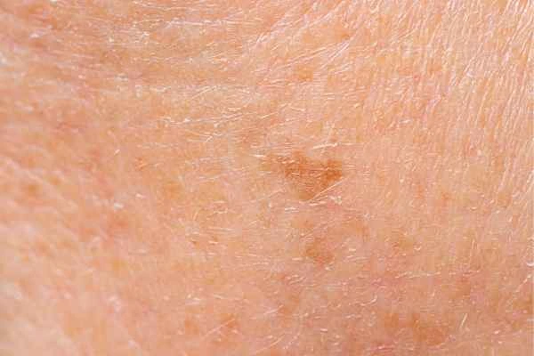 close up picture of age spots Waltham Cross