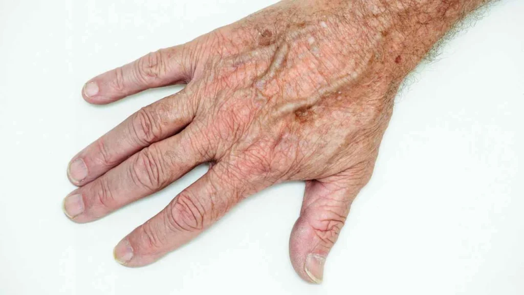 Male hand showing age spot Waltham Cross