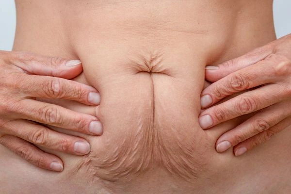 Should I Combine Diastasis Recti Treatment with Body Contouring for Better Results Waltham Cross?