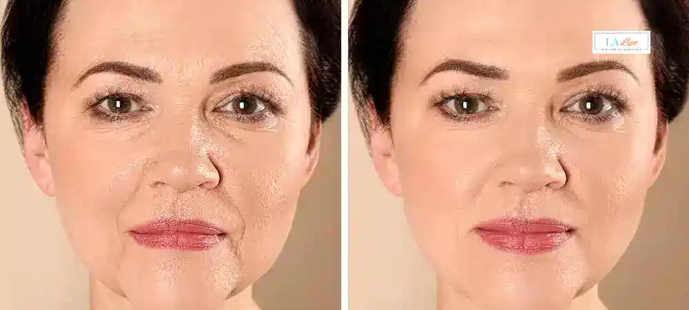 How Long Does It Take to See Results and How Long Do They Last Waltham Cross?