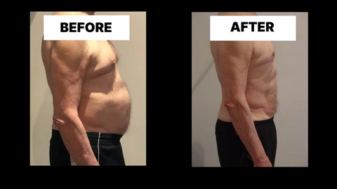 What Symptoms Can Diastasis Recti Cause in Men? Weak Core, Back Pain and Poor Posture Waltham Cross